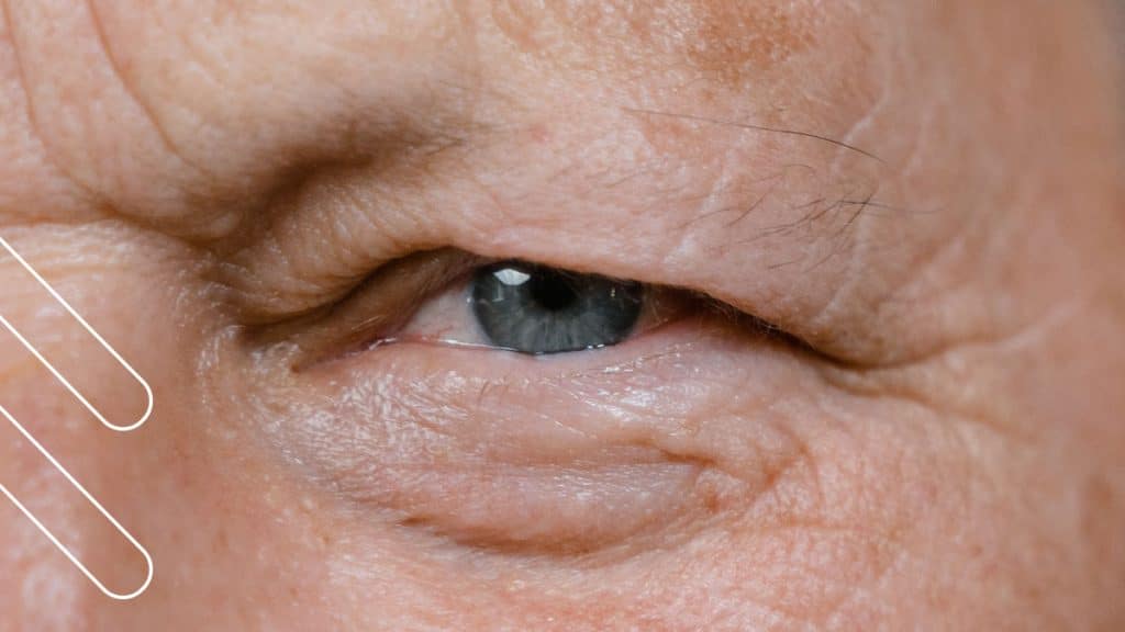 blefaroplastia estética