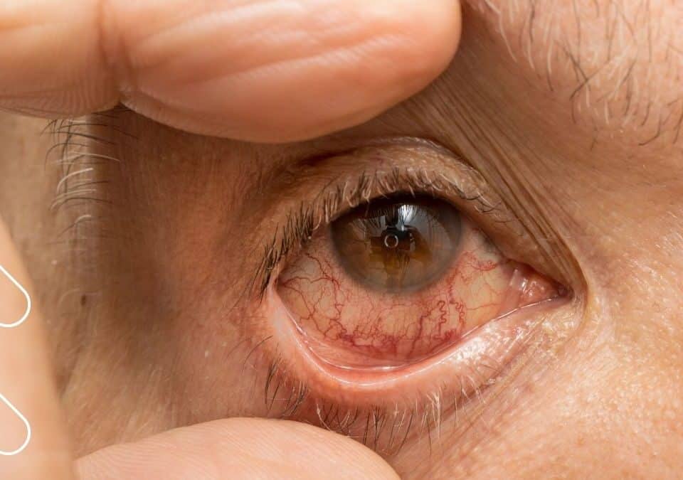 conjuntivitis vírica, conjuntivitis viral