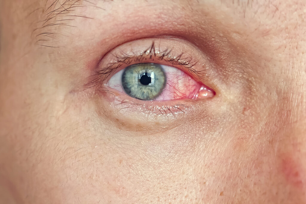 Conjuntivitis en la piscina